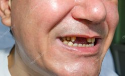 depositphotos_111912794-stock-photo-man-without-and-peeled-teeth.jpg